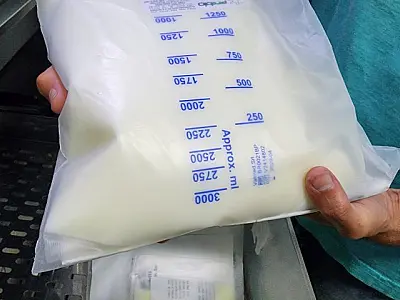 Hospital Regional economiza R$ 1,6 milhão ao modernizar protocolo de Nutrição Parenteral Total