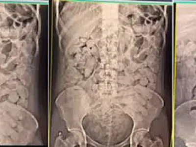 Operação Ágata resulta em prisão de mulheres com cocaína no estômago em MS