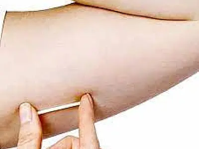 Anvisa impõe novas regras para implantes hormonais e reforça fiscalização sobre uso de chips