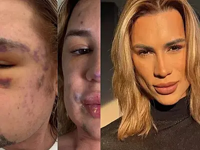 Influenciador, conhecido por seus conteúdos de beleza, morre após procedimento com fios de PDO