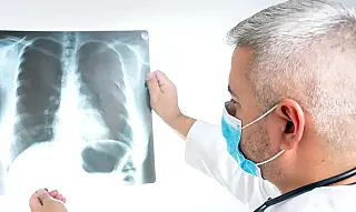 Anvisa aprova novo medicamento para câncer de pulmão avançado